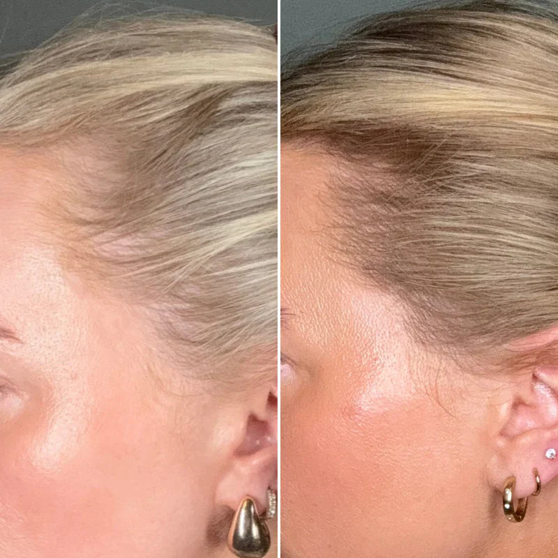 What are the main causes of female hair loss and is it reversible?