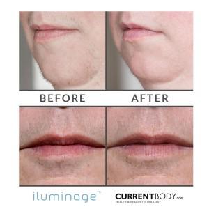 Before and After Hair Removal: iluminage Precise Touch