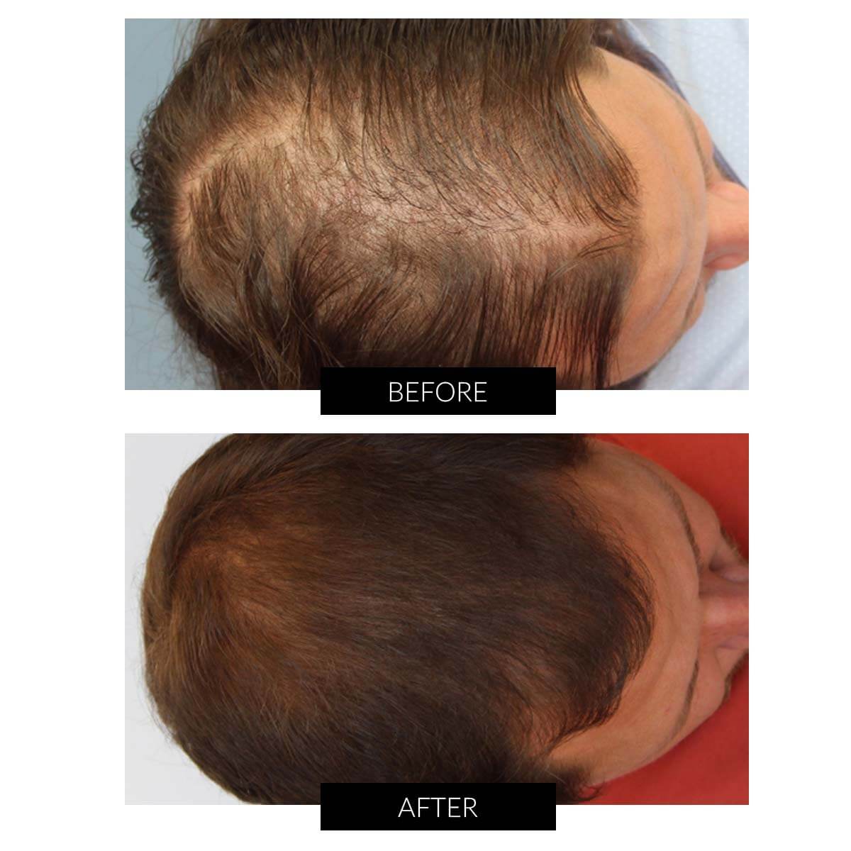 Hair growth cap discount
