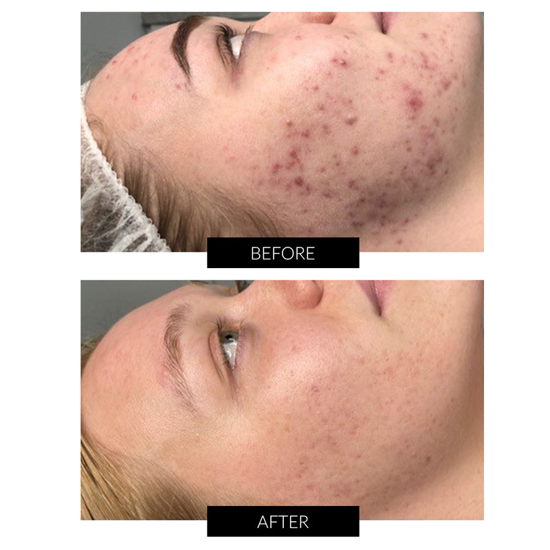 Photobiomodulation Therapy