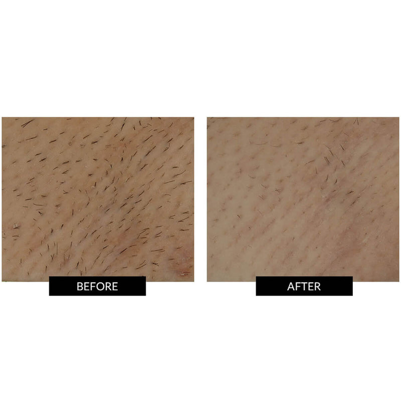 Smoothskin bare+ ipl Clearance