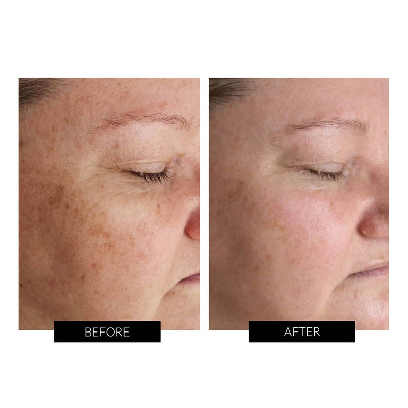 Photobiomodulation Laser