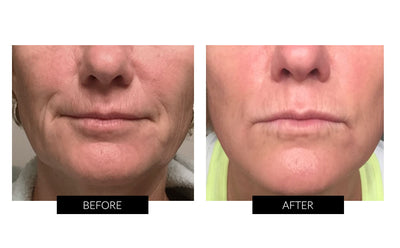 Trophy Skin MicrodermMD Home Microdermabrasion System