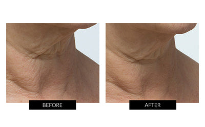 Trophy Skin MicrodermMD Home Microdermabrasion System